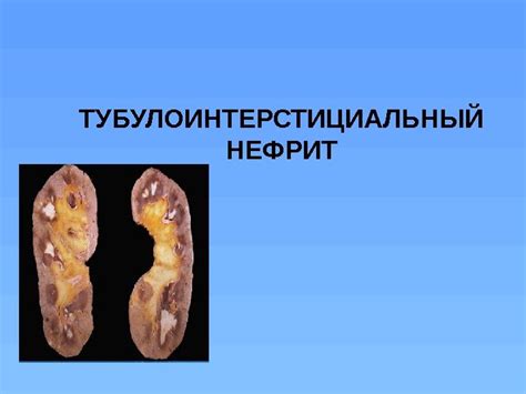 Тубулоинтерстициальный нефрит почек