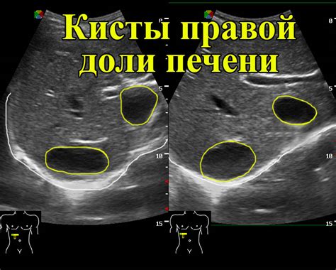 УЗИ печени: повышенная эхоплотность печени