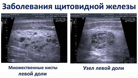 УЗИ щитовидной железы: основные сведения