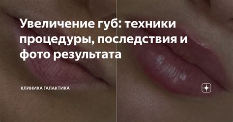 Увеличение губ: суть процедуры и ее последствия