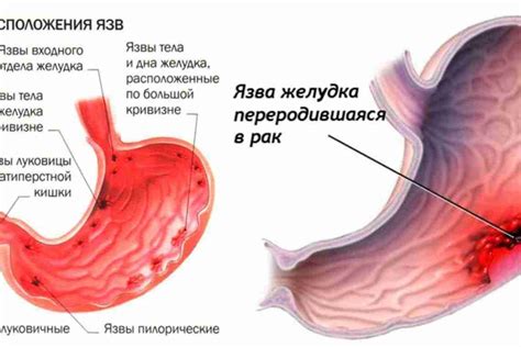 Угол желудка деформирован: причины, симптомы и лечение