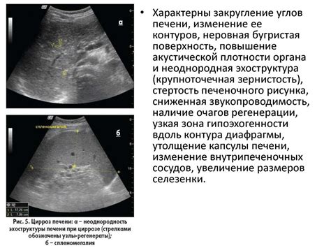 Узи печени: эхоструктура неоднородная