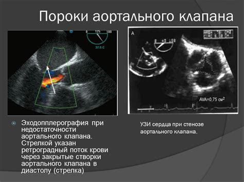 Узи сердца: что значит показатель ФВ 41%?