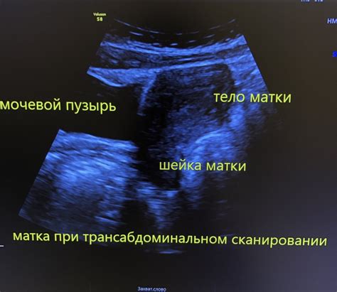 Узи трансабдоминальное: что можно увидеть на изображении