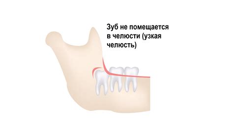 Узкая челюсть: основные симптомы