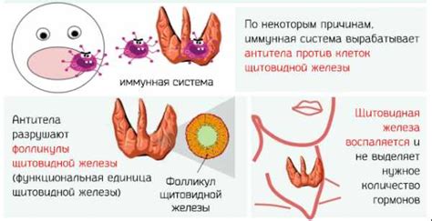 Узловые образования обеих долей щитовидной железы