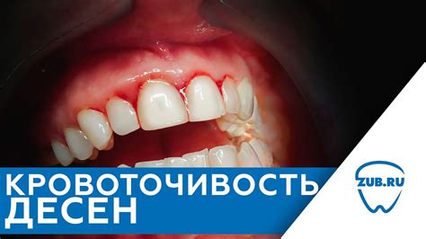 Улучшение состояния десен и предотвращение кровоточивости