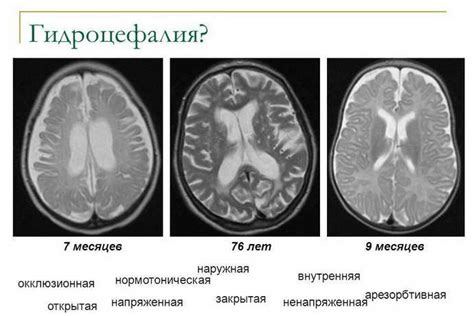 Умеренная гидроцефалия: принципы диеты и режима питания