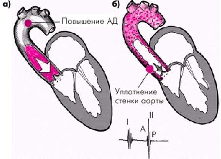 Уплотнение сердечного клапана: что это?