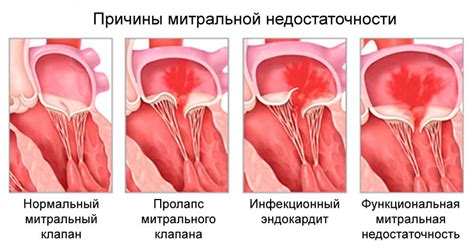 Уплотненные створки митрального клапана: их значение и функции