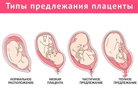 Утолщенная плацента: причины и последствия