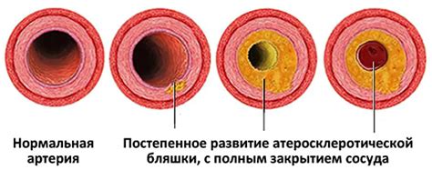 Ущемление сосудов: причина синяков у женщин