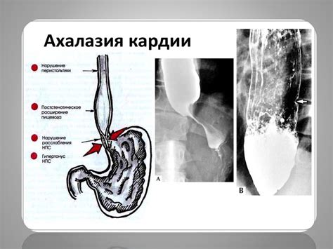 ФГДС и недостаточность кардии: как это влияет на здоровье