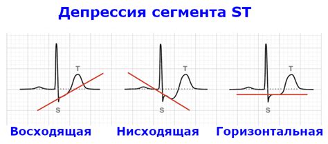 Факторы, влияющие на интерпретацию смещения ST-сегмента