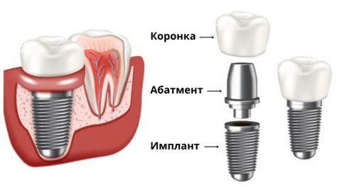 Факторы, определяющие стоимость зубных имплантов