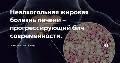 Факторы, приводящие к ощущению дискомфорта в области печени