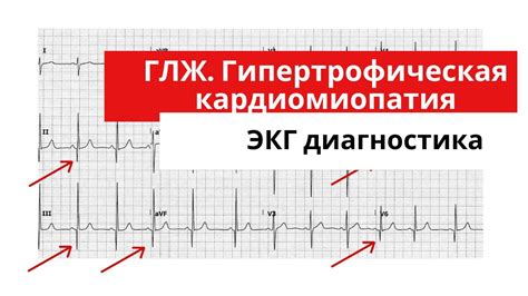 Факторы риска начальной гипертрофии левого желудочка