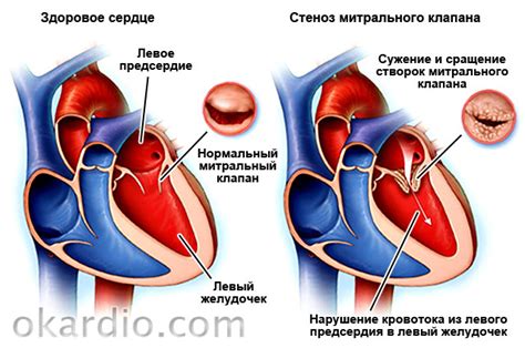 Факт 4: Симптомы увеличенного левого предсердия