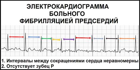 Фибрилляция предсердий тахисистолической формы: основные сведения