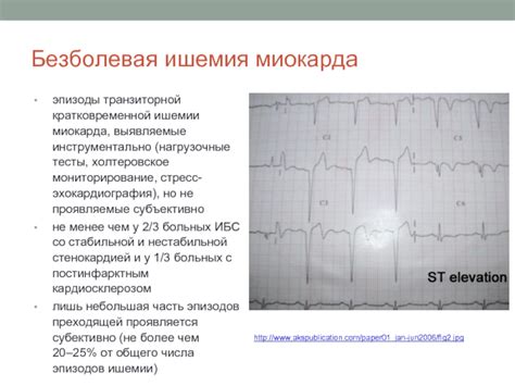 Физический стресс и его связь с нестабильной стенокардией