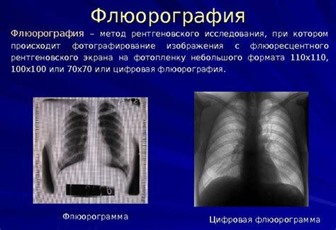 Флюорография ЭЭД: общая информация