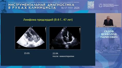 Характеристика эхопозитивных включений