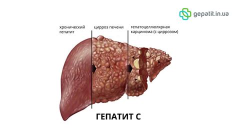 Хронический гепатит C: что это?