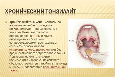 Хронический тонзиллит: основные симптомы