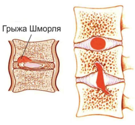 Центральные грыжи шморля: основные причины и симптомы