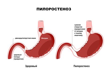 Частая рвота: причины и значения