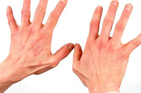 Частые причины отслаивания кожи на руках