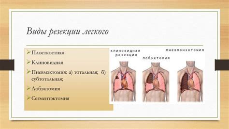 Чем заключается резекция легкого?