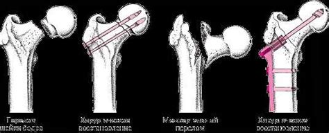 Чрезвертельный перелом: принципы и проблемы лечения