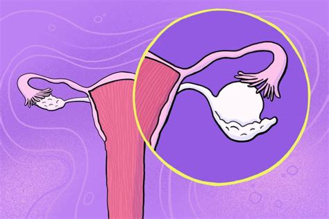 Что говорит о кисте яичника у женщин: симптомы и признаки