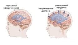 Что делать при повышенном глазном давлении