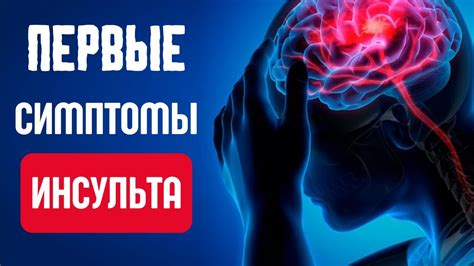 Что значат первые симптомы инсульта?