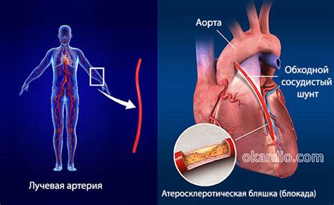 Что значит шунтирование сердца?