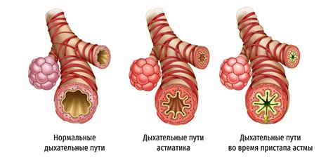 Что означает астма: причины, симптомы и лечение