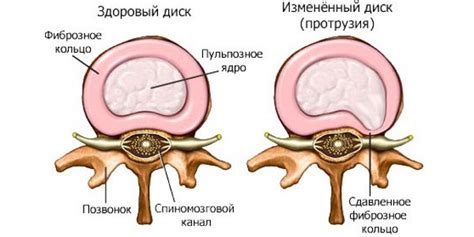 Что означает хруст во всем теле?