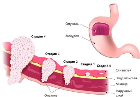 Что означает 4 стадия рака желудка и какие симптомы проявляются?