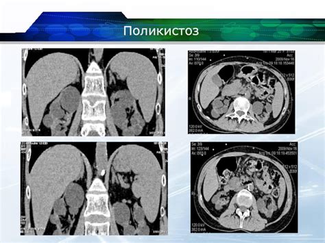 Что означают волнистые контуры почек?