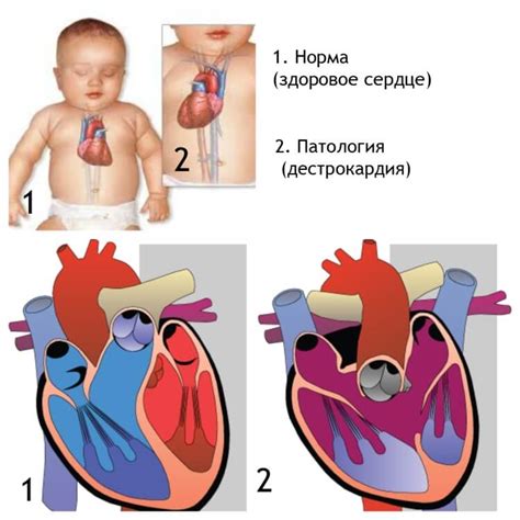 Что означают приглушенные тоны сердца у новорожденных?