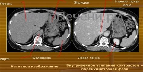 Что показывает увеличение правой доли печени по УЗИ?