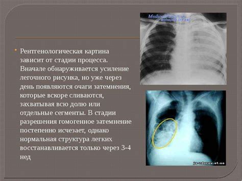 Что такое "усиление корня легкого"?