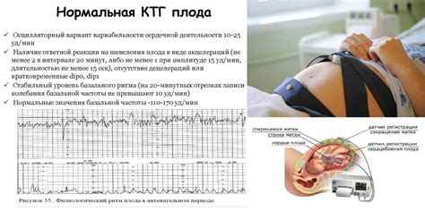 Что такое КТГ и какой у него признак схваток