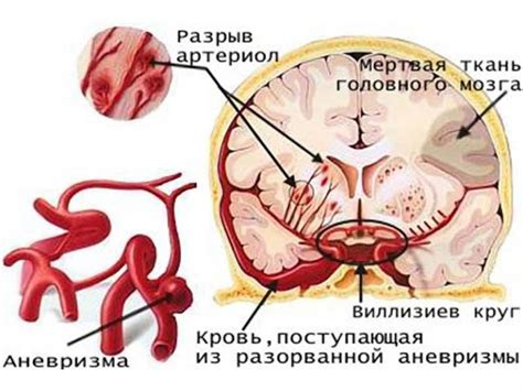 Что такое аневризма головного мозга?