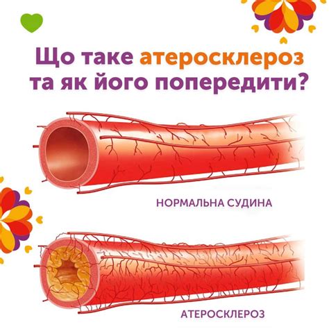 Что такое атеросклероз?