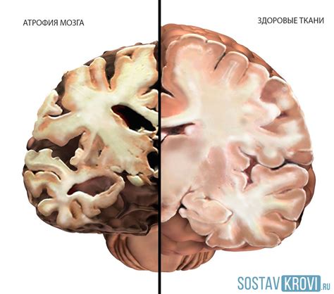 Что такое атрофия мозга и каковы ее причины?