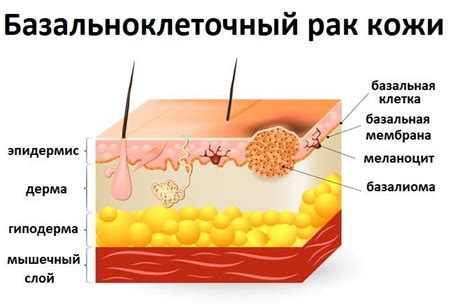 Что такое базальноклеточная карцинома