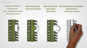 Что такое бифида позвоночника?